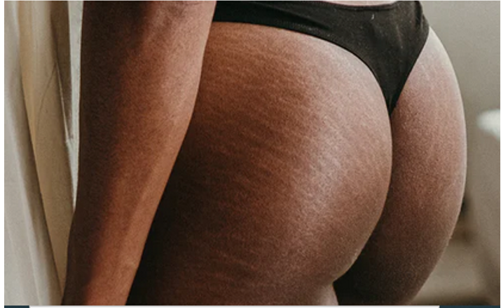 Tips for Choosing the Best Stretch Mark Creams