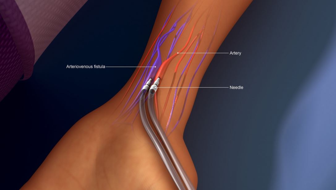 Cardiovascular Access: What You Need to Know